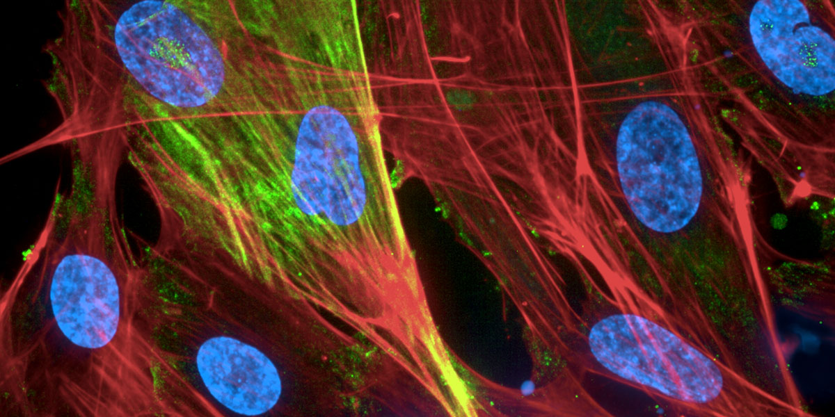 lipotoxicity-fibrosis-1200x627